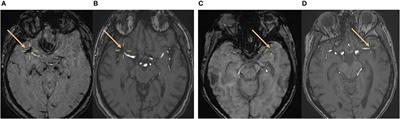 Absence of Susceptibility Vessel Sign in Patients With Malignancy-Related Acute Ischemic Stroke Treated With Mechanical Thrombectomy